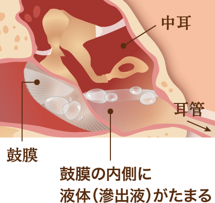 滲出性中耳炎 図解