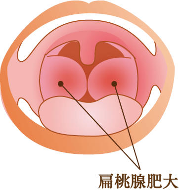 扁桃 腺腫 れ 治す