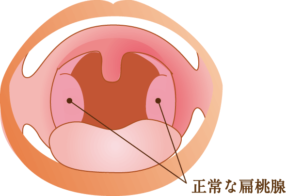 扁桃 腺 白い 治し 方